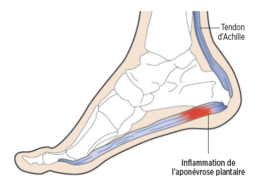 Comment soulager l’aponévrosite plantaire ?